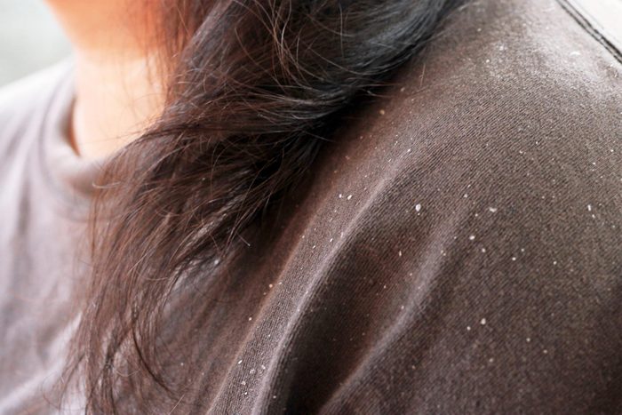 dandruff