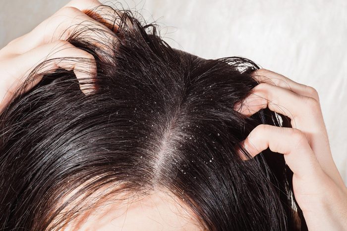 dandruff