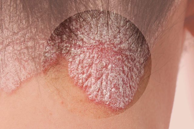 psoriasis