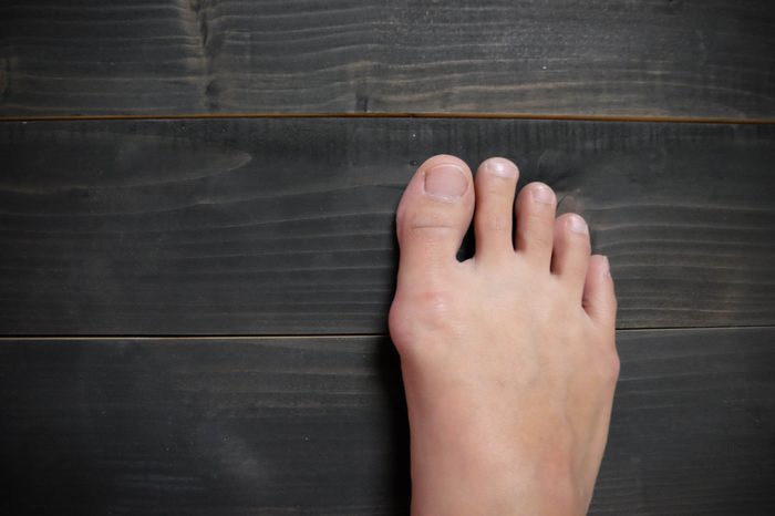 Hallux valgus on wooden background, bunion in foot