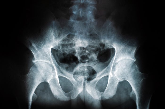 X-ray of a human break hip coxal joint