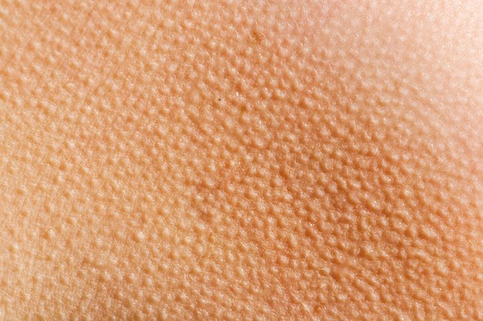 Human skin with goosebumps from the cold