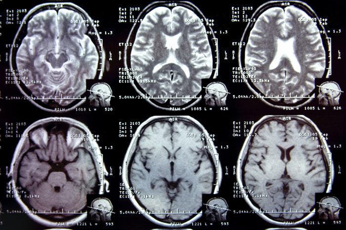 Closeup view of a MRI head scan with brain and skull on it. Blue toned.