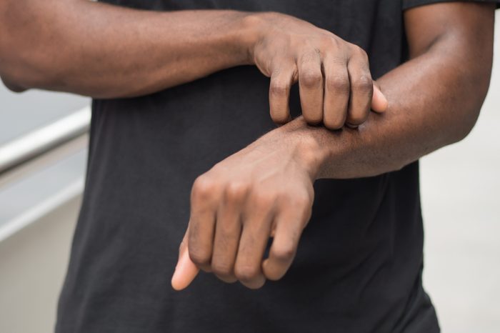 man suffering from itching skin; sick african man scratching his skin with allergy, rash, ringworm, tinea problem; health care, skin care, dermatology concept; adult african man, black man model