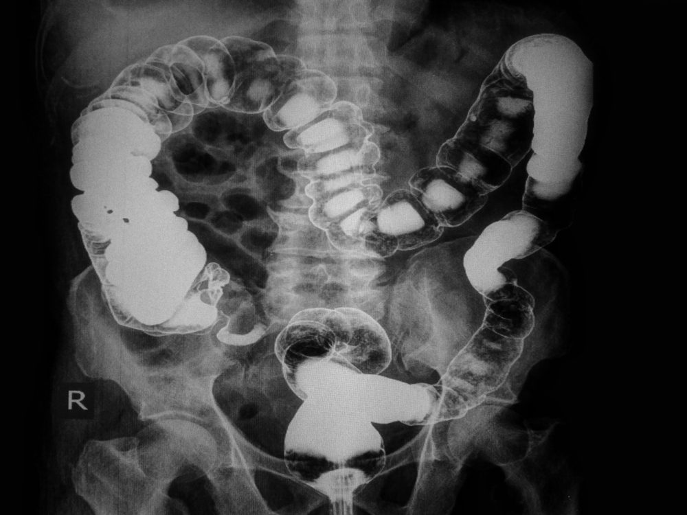 Soft image:Exam spacial examination Barium enema showing Few small diverticulosis in transverse colon.