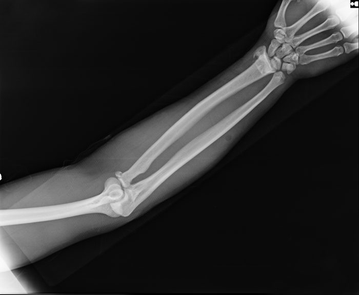 X-ray view of elbow