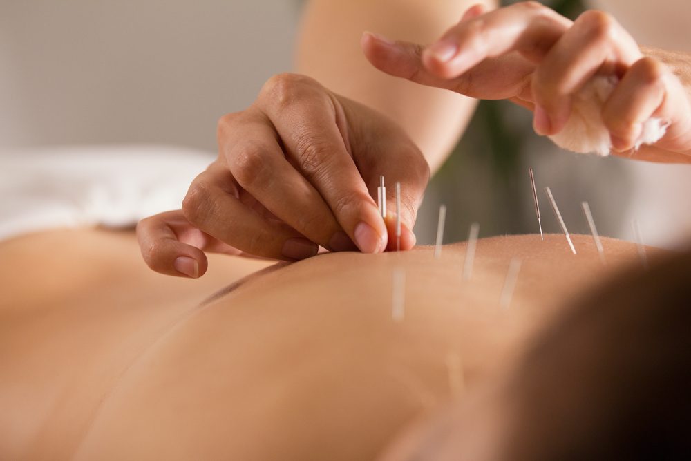 The doctor sticks needles into the girl's body on the acupuncture - close up