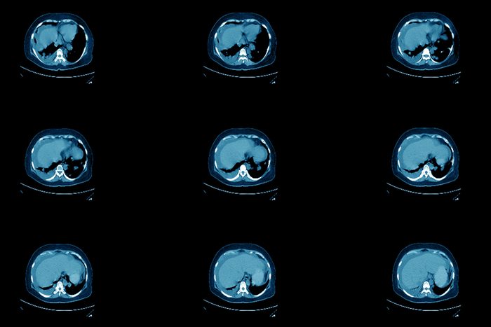 Mri ct scan of human ovaries with cancerous lumps.