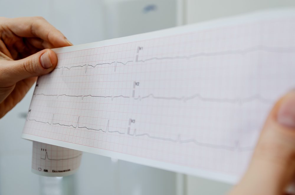  heart health evaluation EKG diagnosis graph test electrocardiogram report at a health care provider facility