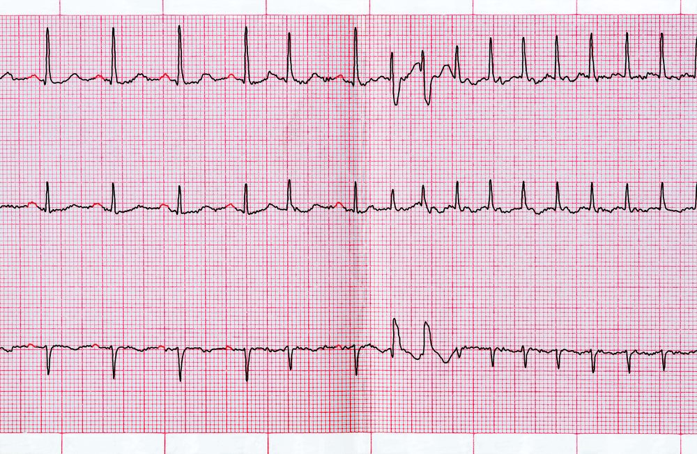 Emergency cardiology. ECG with supraventricular extrasystole and short paroxysm of atrial fibrillation