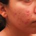 Dr. Pimple Popper Reveals the Type of Acne You Should Never Pop