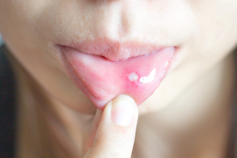 Woman with aphthae on lip.