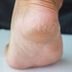 What Really Causes Cracked Heelsâ€”and How to Get Rid of Them