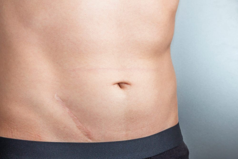 Young man with scar after surgery on abdomen, removal of appendicitis. Scars removal concept.