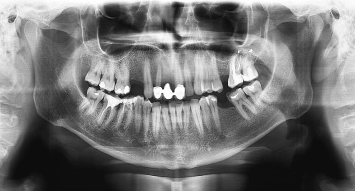 Original black white x-ray teeth scan mandible. Panoramic negative image facial of young adult male. Photo was taken on digital system equipment for dental diagnostic examination upon clinical checkup
