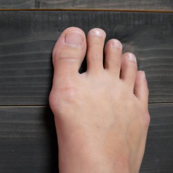 foot bunion