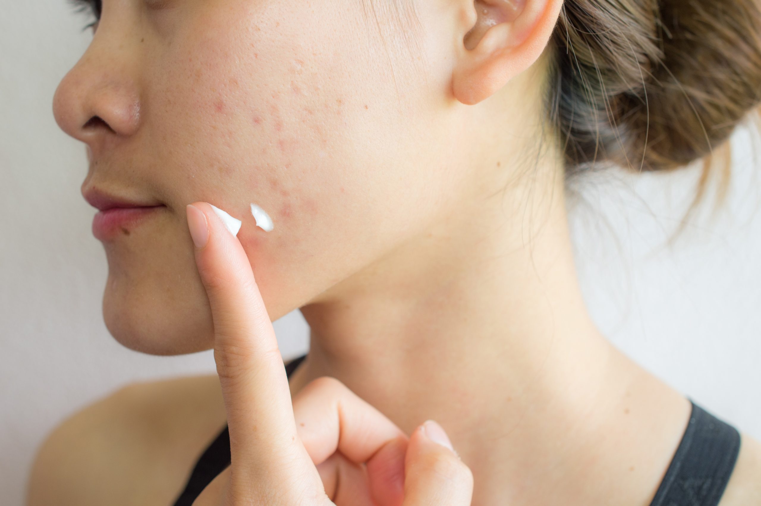 Portrait of young Asian woman having acne problem. Applying acne cream on her face.