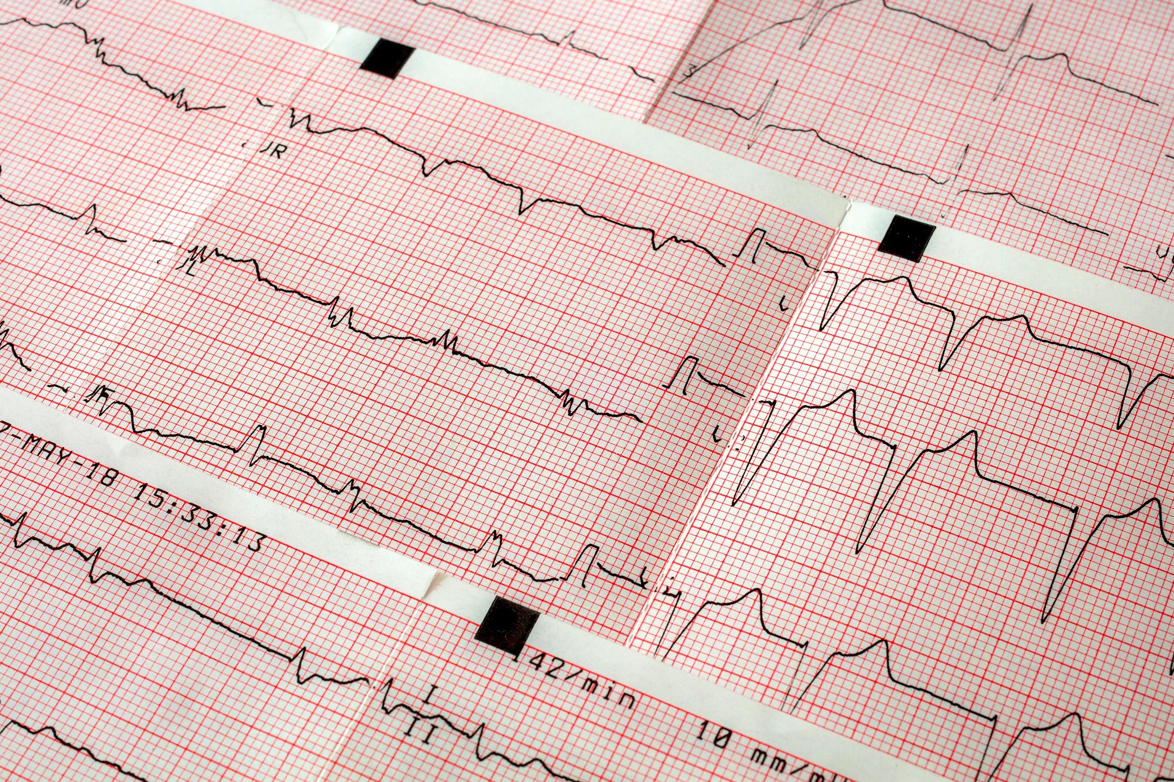 electrocardiogram