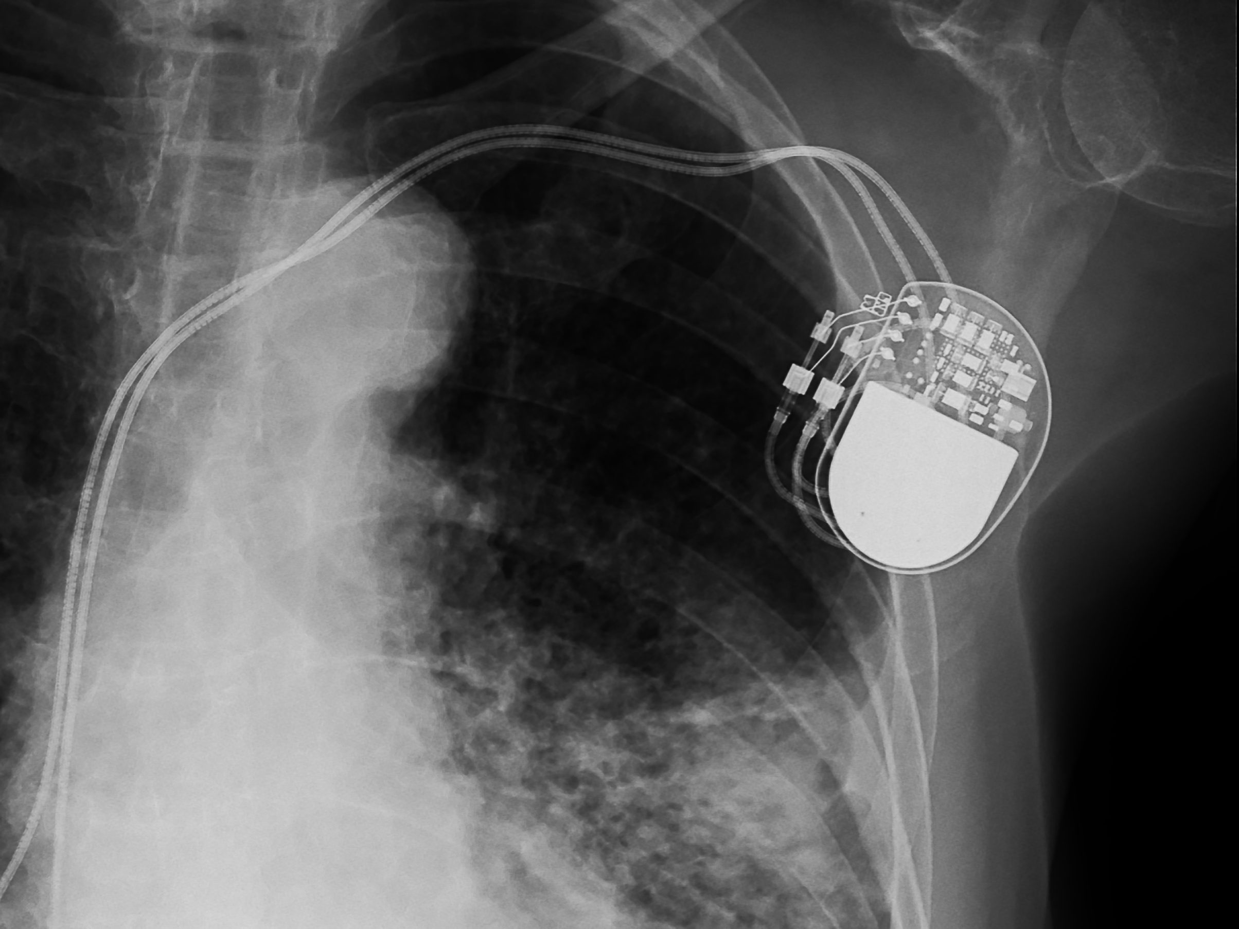 x-ray image of permanent pacemaker implant in body chest.