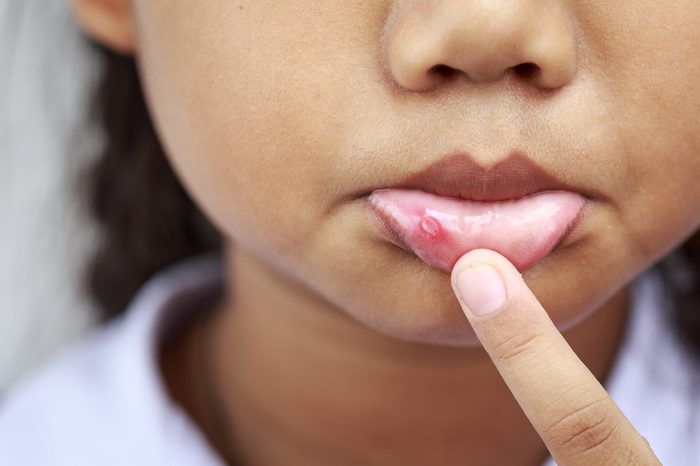 Close up Children with aphtha on lip