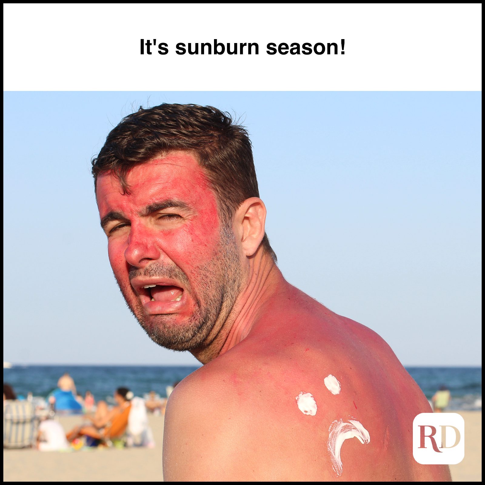 Man crying with sunburn MEME TEXT: It's sunburn season!