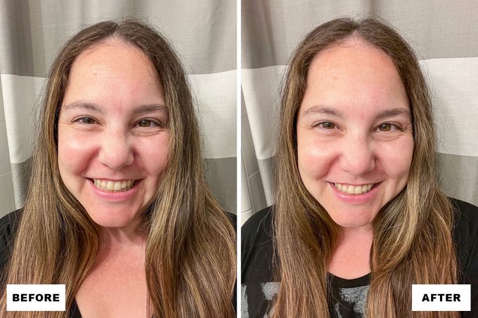 Sio Beauty Wrinkle Patches Before and After Results