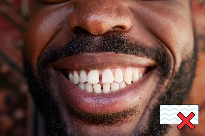 man smiling with teeth with a "no magic eraser symbol" in the corner